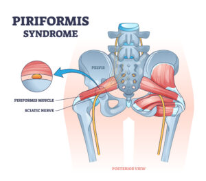 Causes-of-Piriformis-Syndrome
