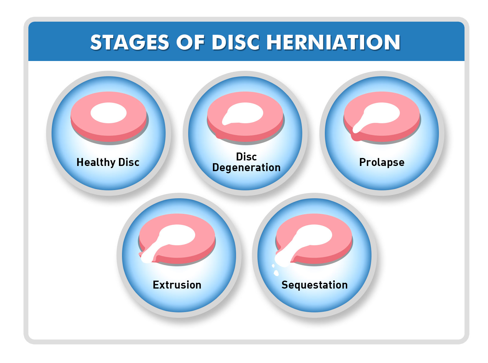 stages of disc herniation canton oh chiropractor