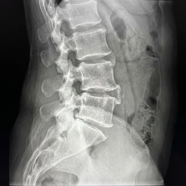 Side-view X-ray of the lumbar spine showing age-related changes linked to spinal stenosis